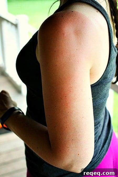 Lavender Aloe Skin Tonic for Calming & Hydrating Sensitive Skin 3 Severe sunburn from shoulder to wrist